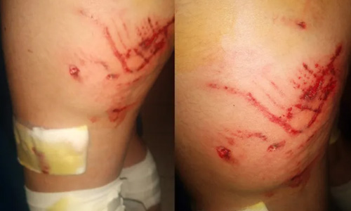 Una jauria de perros ataco a una niña de 14 años  